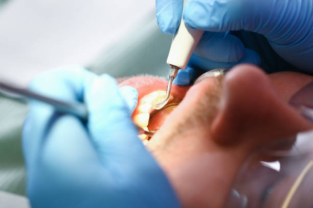 Emergency Dental Filling Replacement in CT